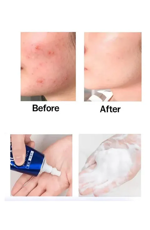 [LION] Pair Acne Creamy Foam (80g/2.7fl.oz)