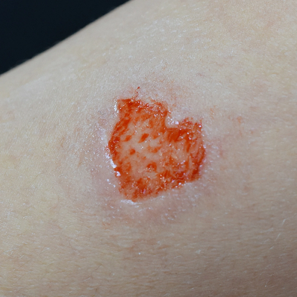 Out of Kit Second Degree Burn 1